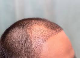 Maximizing Value with Haartransplantation Türkei Kosten Solutions